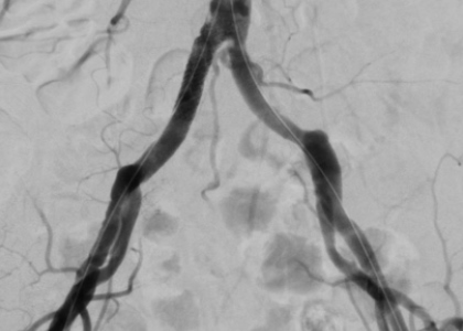 Mit Kontrastmittel aufgenommene Darstellung von Arterien. Sie sind auf der Darstellung schwarz auf hellgrauem Hintergrund deutlich zu erkennen.